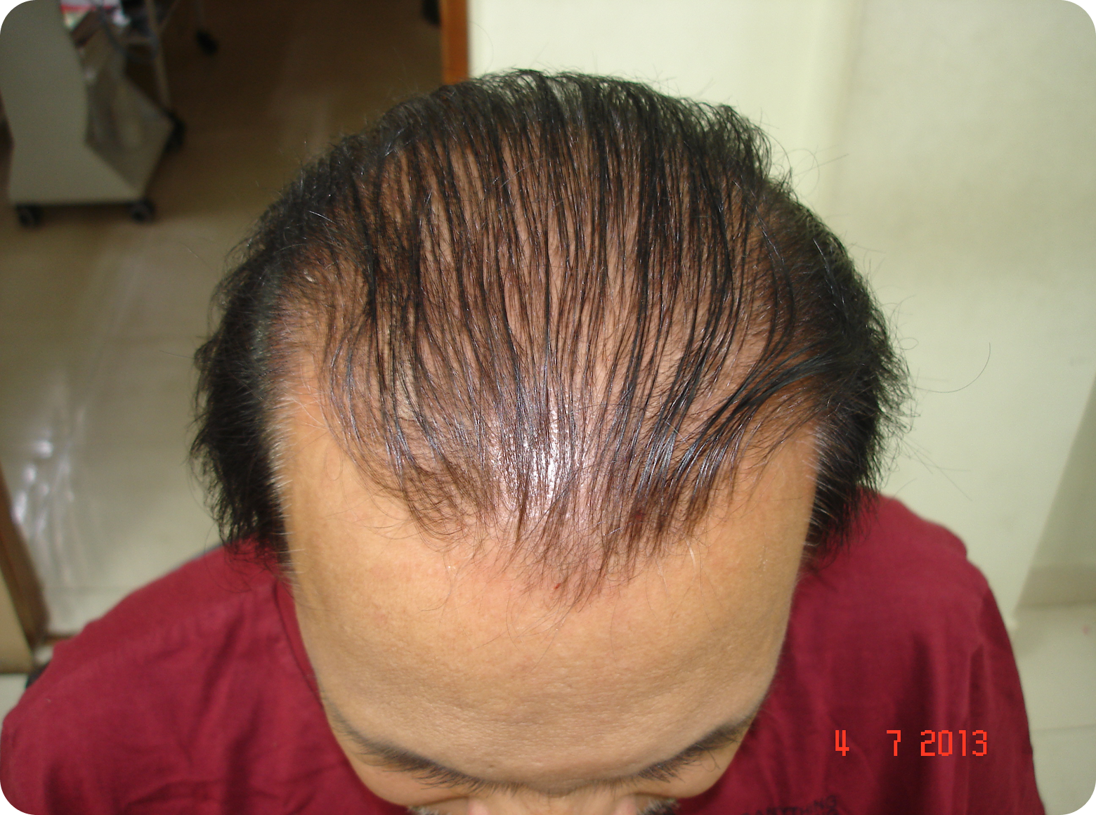 1after